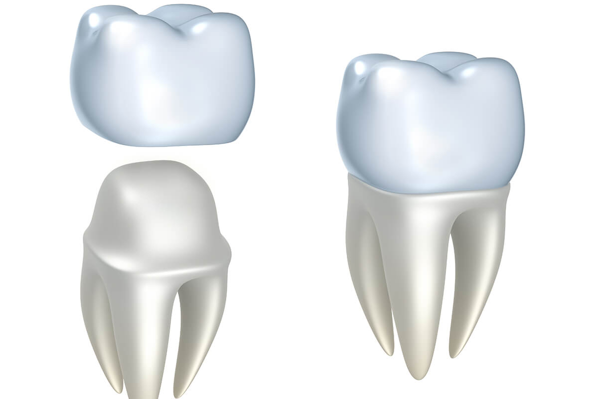 Types of Dental Crowns in Naperville IL Area