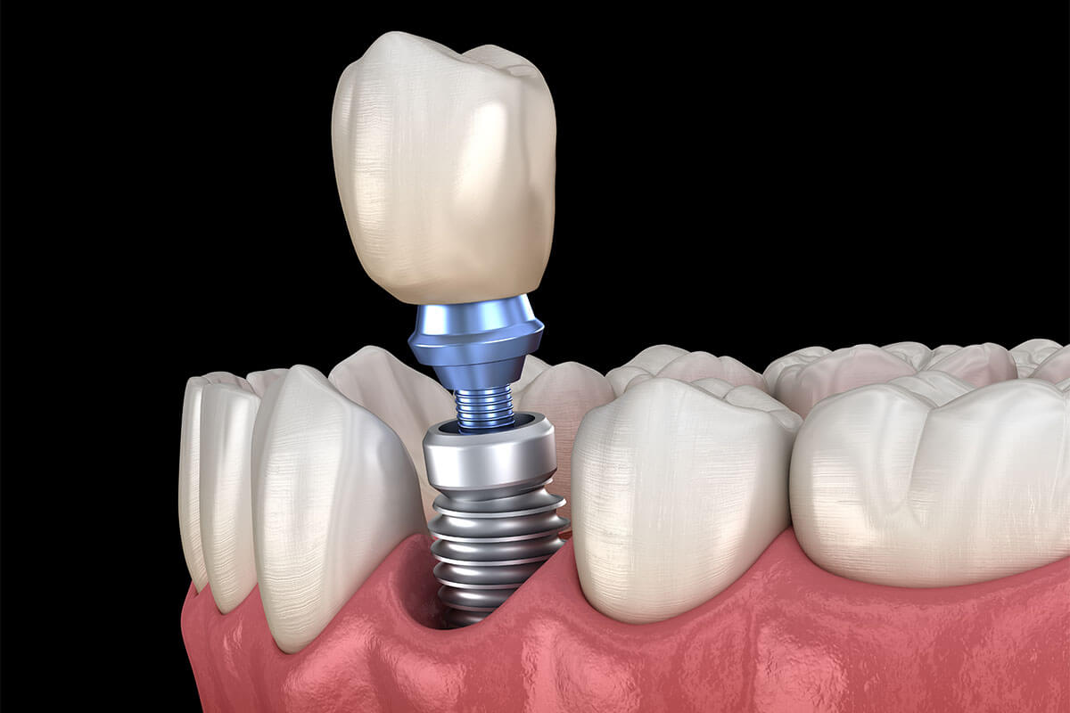 Dental Implants Options in Naperville IL Area